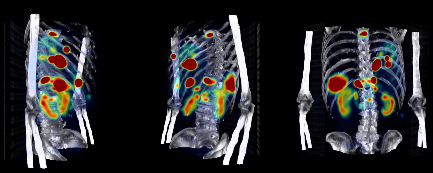 Hermia Voxel dosimetry showing a dosemap MIP fused with CT
