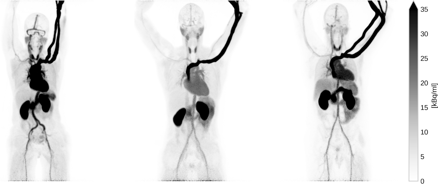 Nuclear medicine scans. Maximum intensity projection (MIP) of the three subjects at rest. The images depict the full scan integration